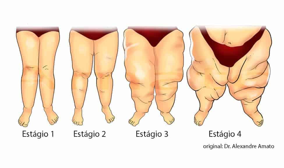 lipedema